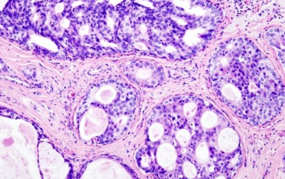 Wechselwirkungen zwischen Tumor- und Bindegewebszellen fördern Metastasenbildung
